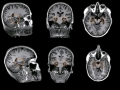 Sono baresi i migliori algoritmi per diagnosticare l&#039;Alzheimer